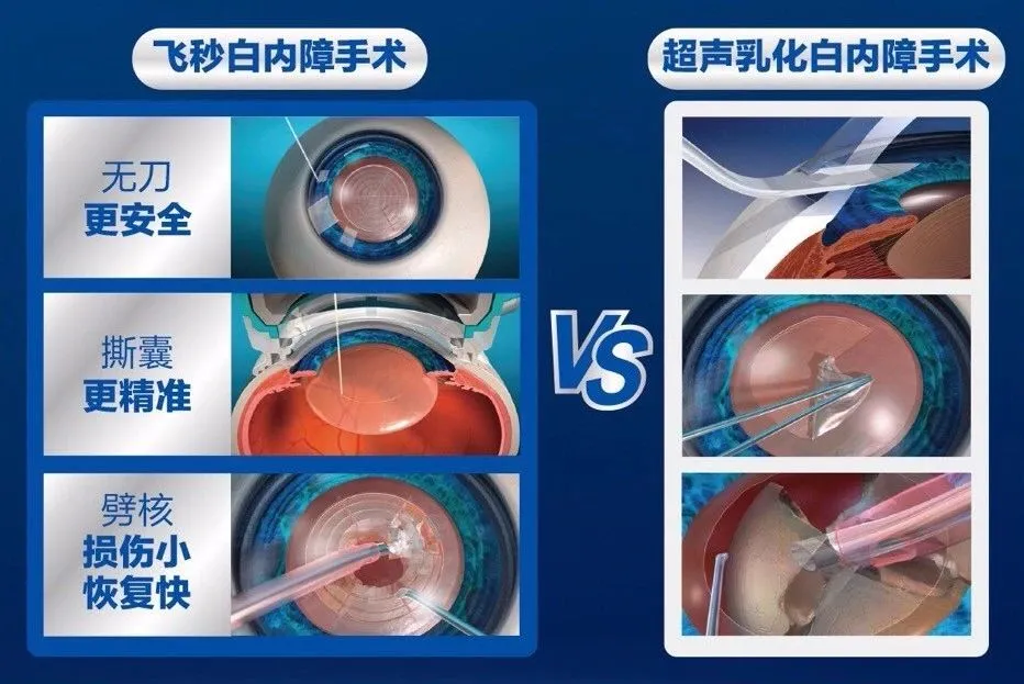 飞秒激光白内障