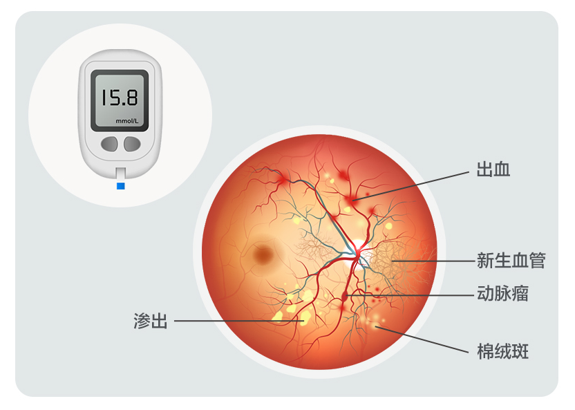 糖尿病视网膜病变